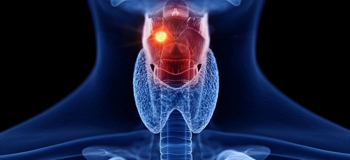 Radioterapia pentru cancerul rinofaringian – CAZ